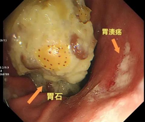 男子山楂和栗子一起吃胃里长出8厘米石头-趣考网