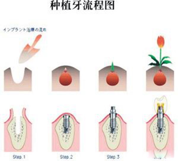 为什么医生不建议种植牙 这种说法有依据吗?植牙可怕吗-图5