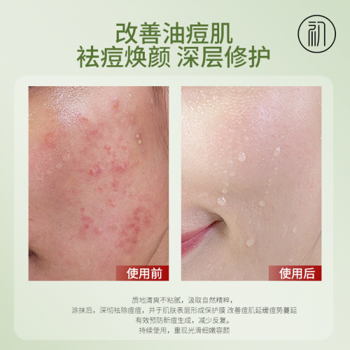 祛痘品牌哪个效果最好？十大高口碑推荐，适合学生的祛痘方法-图4