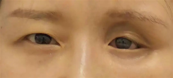 女子眼睛里竟藏了23个隐形眼镜！像煎饼一样叠着 竟无知觉-图2