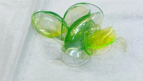 女子眼睛里竟藏了23个隐形眼镜！像煎饼一样叠着 竟无知觉-图8