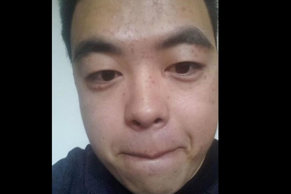 扁平疣早期图片大全 脸上长了这个东西要赶快治疗的-图2