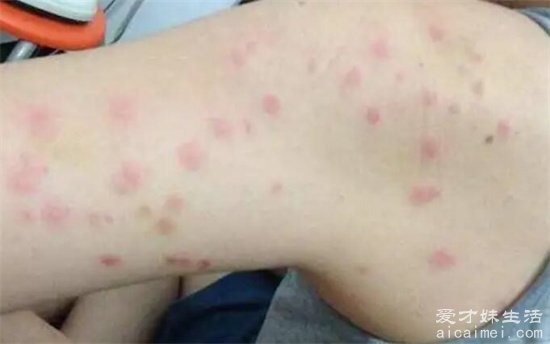 床上螨虫咬的症状图片,红疹发痒看上去吓人(皮肤会有很大的变化)-图1 床上螨虫咬的症状图片,红疹发痒看上去吓人(皮肤会有很大的变化)-图1