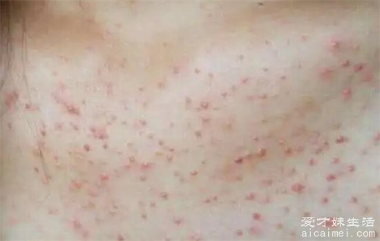 床上螨虫咬的症状图片,红疹发痒看上去吓人(皮肤会有很大的变化)-图3 床上螨虫咬的症状图片,红疹发痒看上去吓人(皮肤会有很大的变化)-图3