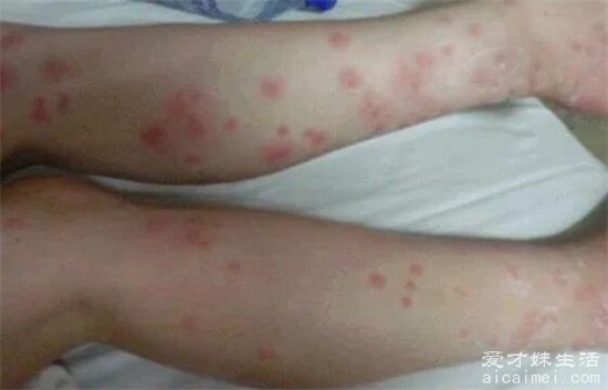 床上螨虫咬的症状图片,红疹发痒看上去吓人(皮肤会有很大的变化)-图5 床上螨虫咬的症状图片,红疹发痒看上去吓人(皮肤会有很大的变化)-图5