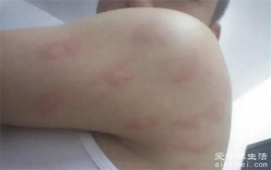 床上螨虫咬的症状图片,红疹发痒看上去吓人(皮肤会有很大的变化)-图6 床上螨虫咬的症状图片,红疹发痒看上去吓人(皮肤会有很大的变化)-图6