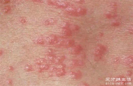 床上螨虫咬的症状图片,红疹发痒看上去吓人(皮肤会有很大的变化)-图7 床上螨虫咬的症状图片,红疹发痒看上去吓人(皮肤会有很大的变化)-图7