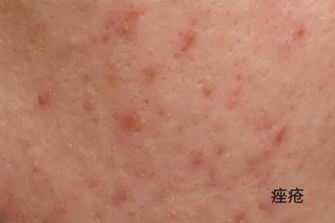 几块钱一管的维A酸乳膏：是护肤圣品 还是致癌毒物(图3)