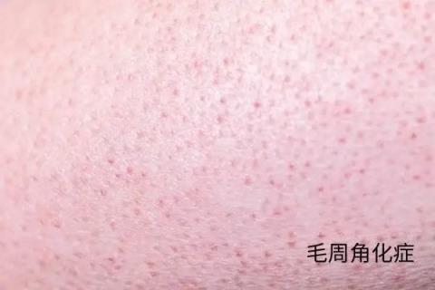 几块钱一管的维A酸乳膏：是护肤圣品 还是致癌毒物(图5)