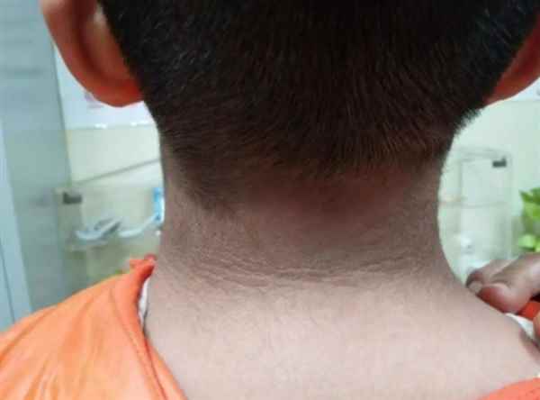 13岁男孩脖子洗不干净确诊黑棘皮病：胰岛素失控所致(图1)