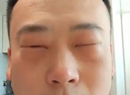 男子吃蝉蛹过敏眼睛肿成“奥特曼” 医生：高蛋白食物或危及生命(图2)