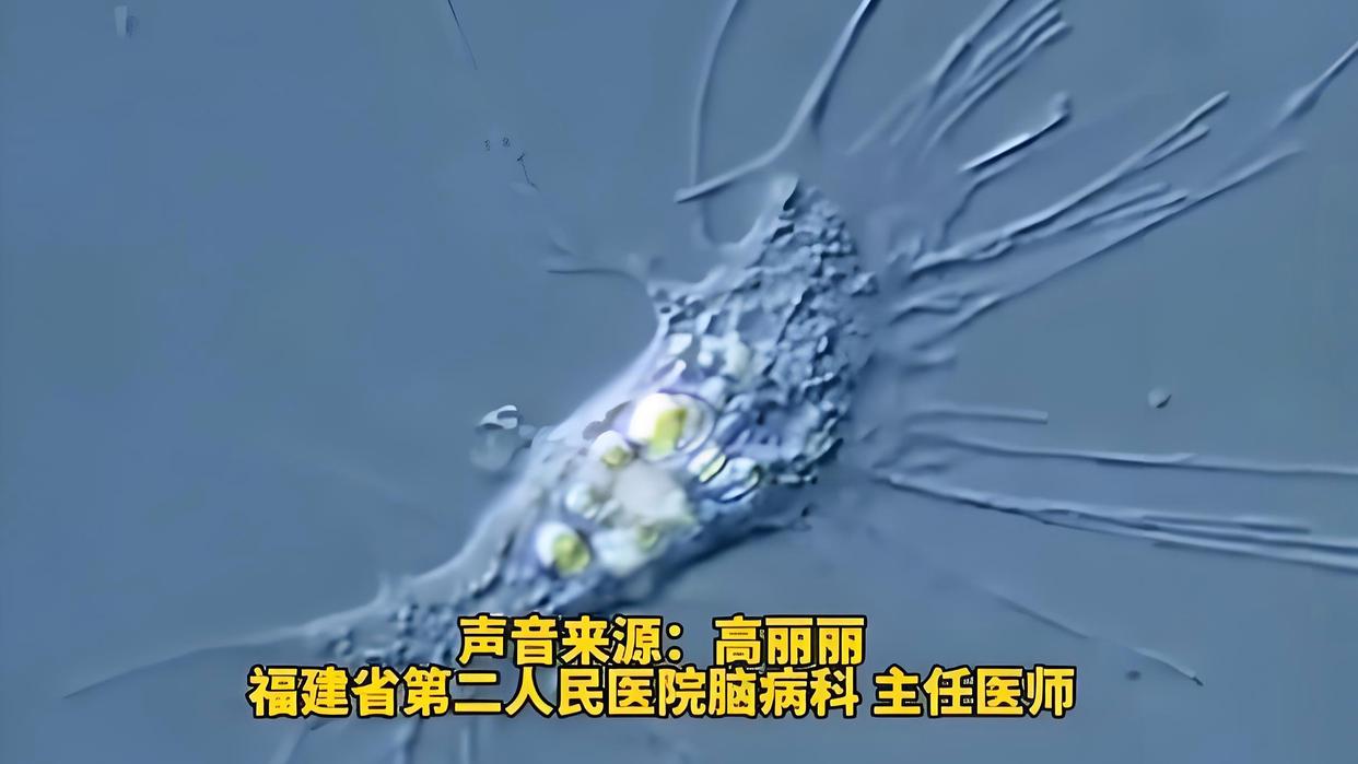 女童感染“食脑虫” 抢救60天后去世