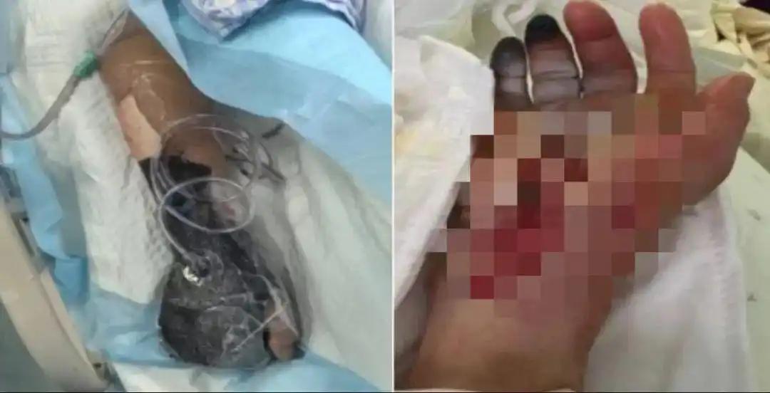 6岁娃光脚踩到死鱼进了ICU?家属回应