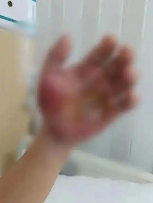 6岁娃光脚踩到死鱼进了ICU?家属回应