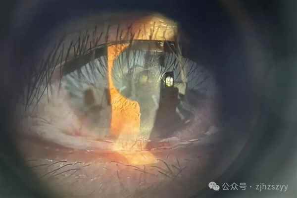男子野外偶遇五步蛇想抓来玩：蛇毒喷到眼睛里差点失明(图2)