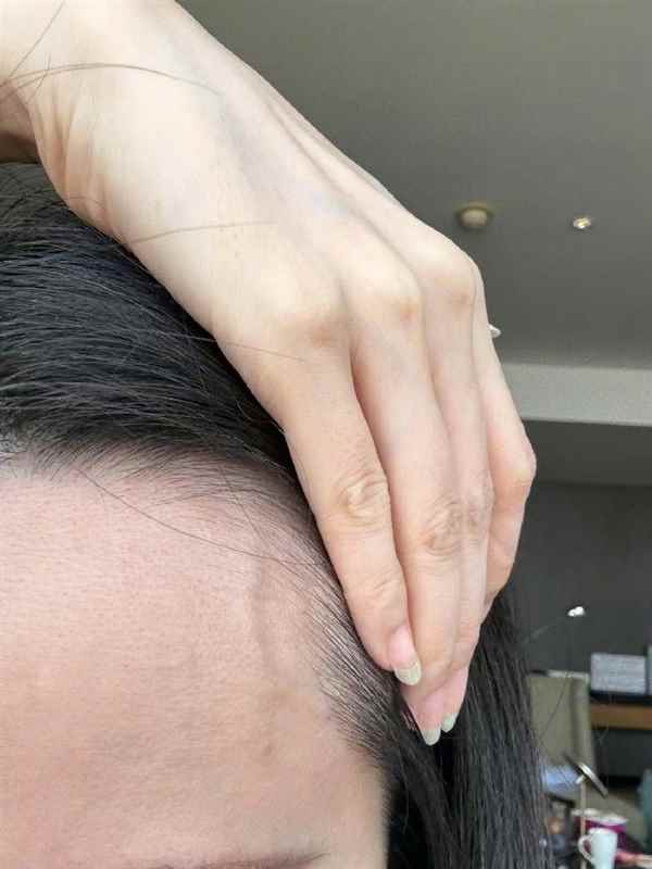 张靓颖自曝体检查出营养不良：额头血管莫名突起 伸懒腰手掌就流血(图1)
