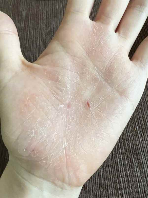 张靓颖自曝体检查出营养不良：额头血管莫名突起 伸懒腰手掌就流血(图2)