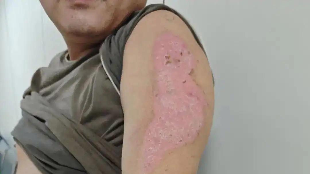 丈夫两次冲进火场救妻双双烧伤