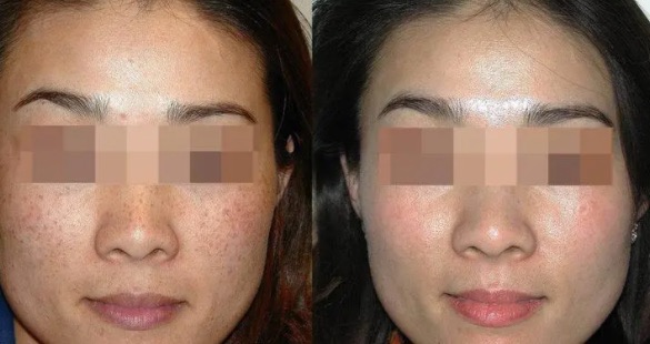 激光祛斑效果怎么样(激光祛斑有什么后遗症)-图3 激光祛斑效果怎么样(激光祛斑有什么后遗症)-图3