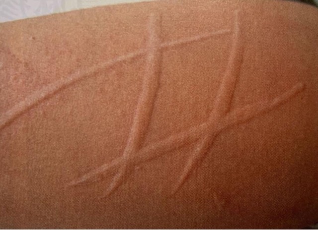 全球最奇葩的十种过敏反应(过敏是什么原因引起的)-图5 全球最奇葩的十种过敏反应(过敏是什么原因引起的)-图5