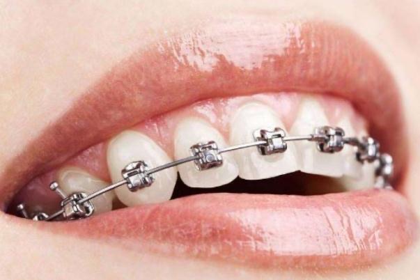 牙套的种类和价格?牙套价格一般是多少钱一个-图1 牙套的种类和价格?牙套价格一般是多少钱一个-图1