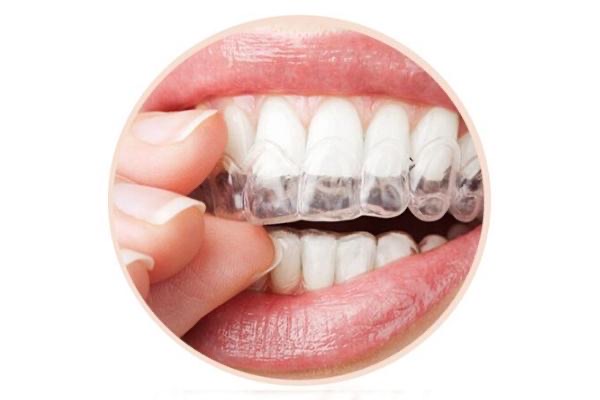 牙套的种类和价格?牙套价格一般是多少钱一个-图2 牙套的种类和价格?牙套价格一般是多少钱一个-图2