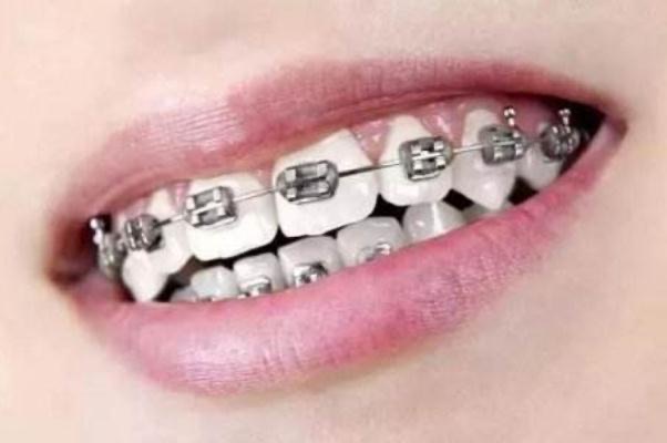 牙套的种类和价格?牙套价格一般是多少钱一个-图3 牙套的种类和价格?牙套价格一般是多少钱一个-图3