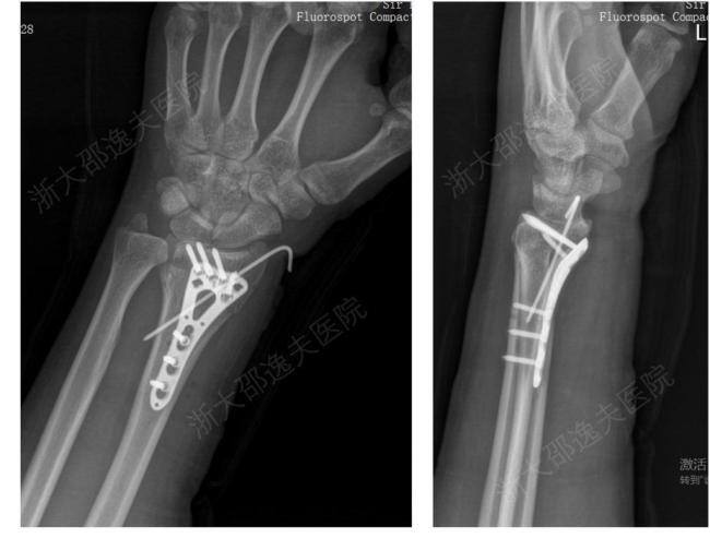 全球首款骨胶水“骨02”发布 革新骨折治疗模式