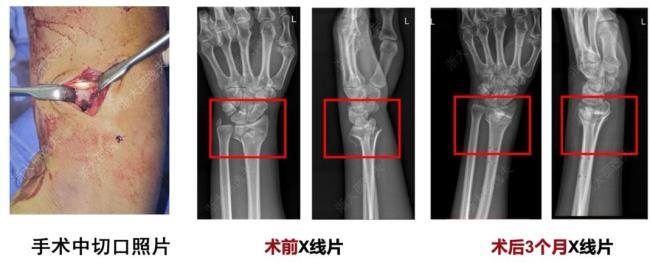 全球首款骨胶水“骨02”发布 革新骨折治疗模式