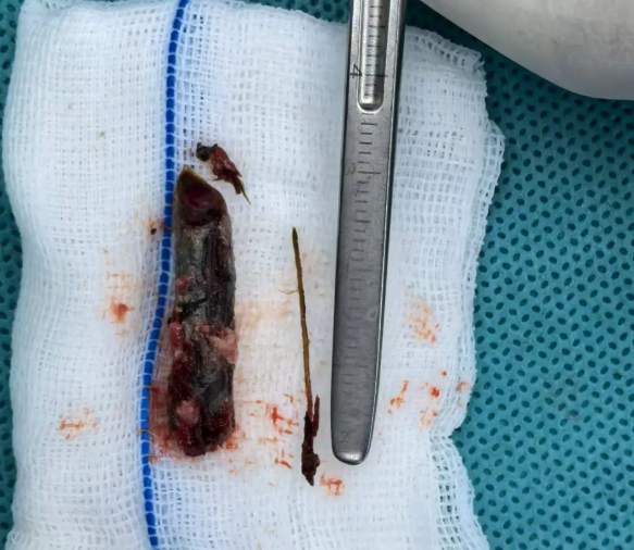 男子鼻痛18年疑骨瘤 开刀取出3cm树枝-图2