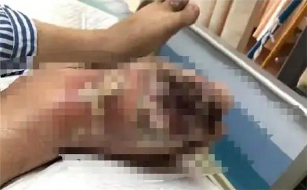 险些截肢！男子每天喝3罐可乐痛风石撑破皮肉 伤口溃烂巨大-图1