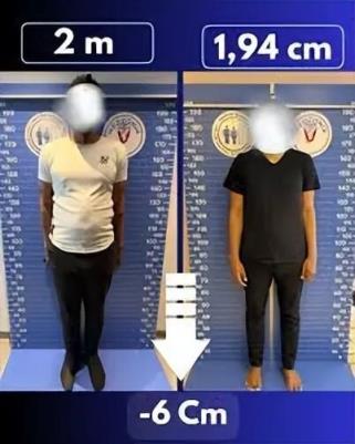 太疯狂！嫌个子太高不好找对象 女子手术切骨变矮(图6)