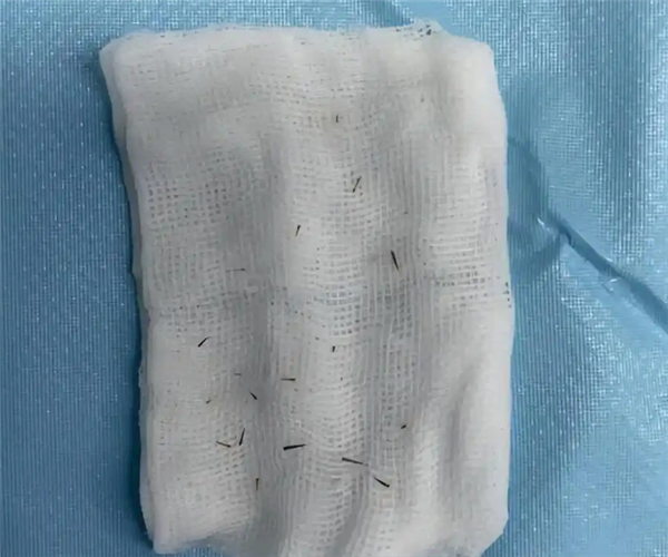 男子左眼扎入19根刺 医生紧急提醒:每年9月高发-图2 男子左眼扎入19根刺 医生紧急提醒:每年9月高发-图2