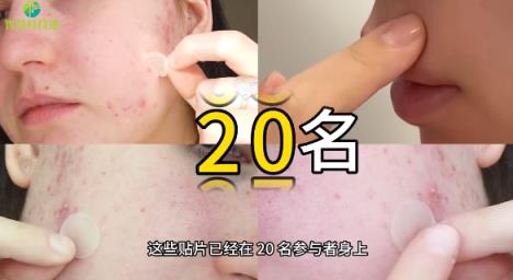 韩国开发出一种智能贴片：3D打印形成 7天内可消除青春痘(图2)