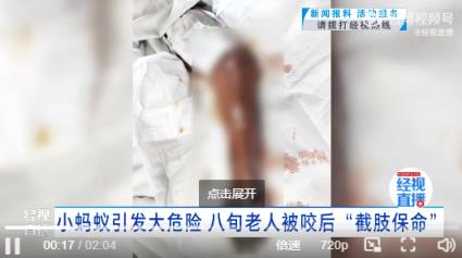 老人手被被蚂蚁咬一口 没在意竟需截肢保命  医生：咬伤后 警惕“危险信号”(图1)