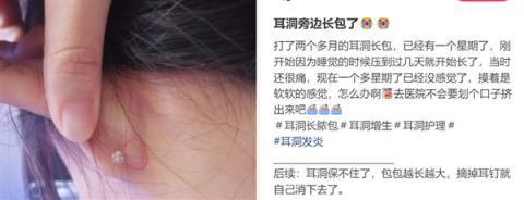 为什么没有人告诉我 打耳洞后会长这种肉疙瘩啊(图1)