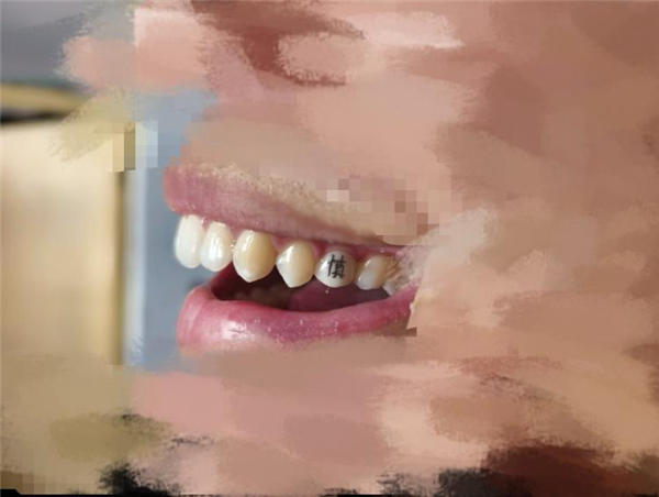 “发财”“上岸”刻牙上 牙齿上刻字成新玄学!专家:不建议
