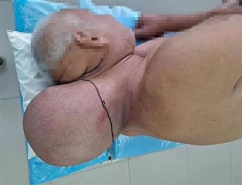 拒绝就医16年 俄罗斯男子颈部长出“头状肉球”：睡觉只能侧躺(图1)