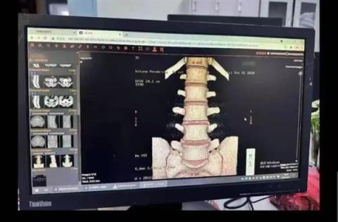 小伙学冲浪闪了腰致截瘫：确诊罕见病“冲浪者脊髓病”(图1)