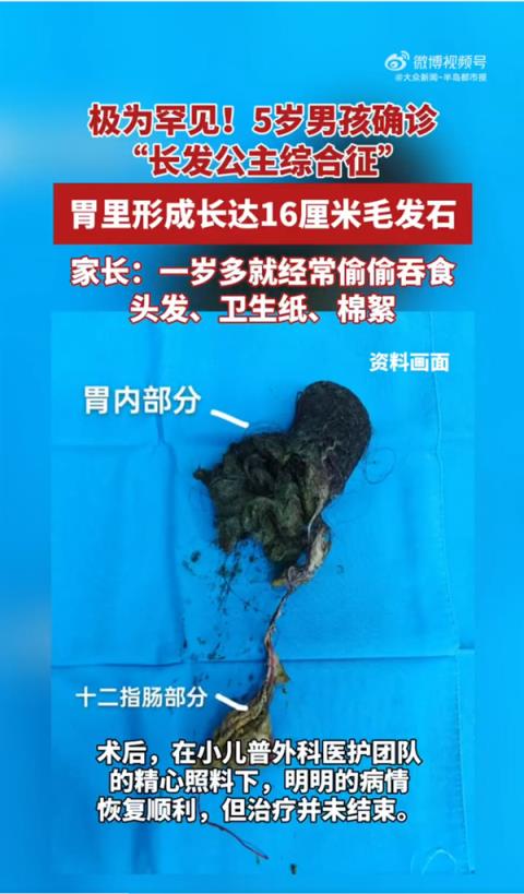 极为罕见！5岁男孩确诊“长发公主综合征” 胃里取出长达16厘米毛发石
