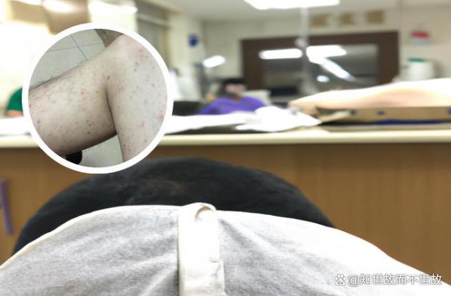 注意!“最疼皮肤病”正高发!女子怀孕30周突发?全身脓疱