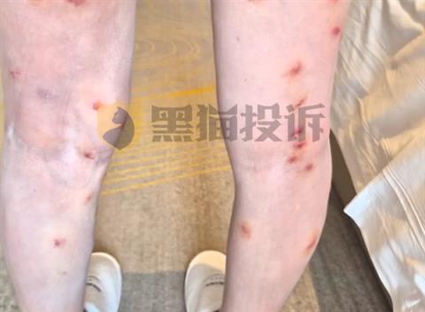 女子住酒店被跳蚤咬70多个包：酒店没赔偿 挂号费都是自己出的(图1)