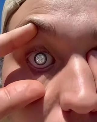 走在路上怕被抢 美国男子定制最昂贵义眼!成本200万美元(图3)