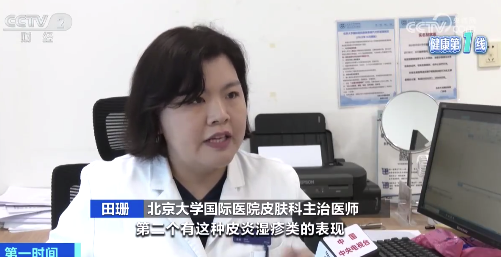 注意!这种过敏性皮肤病可发生于全生命周期