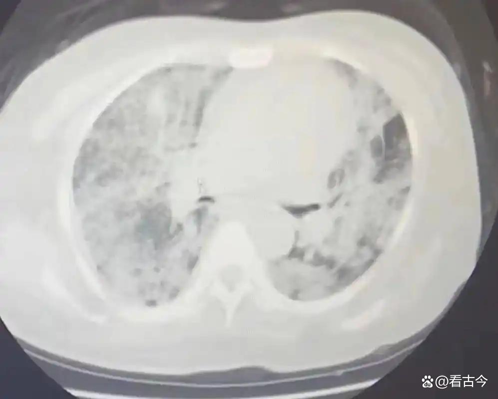 发霉玉米竟成肺部“杀手”?女子接触后肺部全白