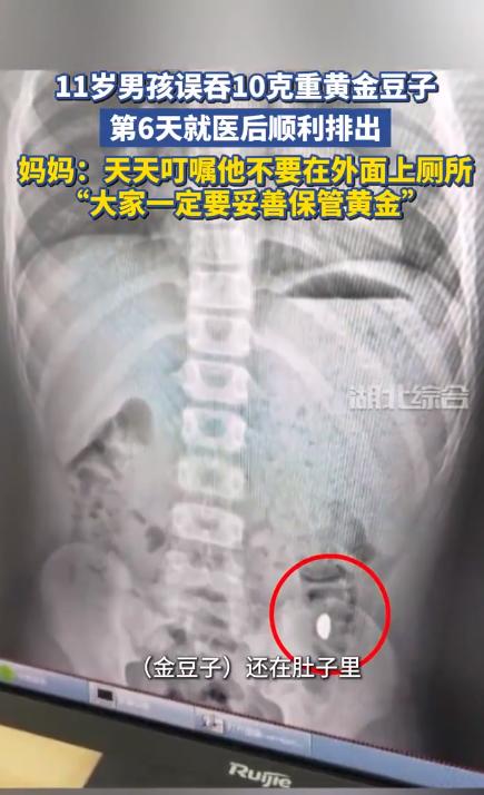 5岁男童误吞10克金饰 妈妈急哭叮嘱“千万别在外拉便便”