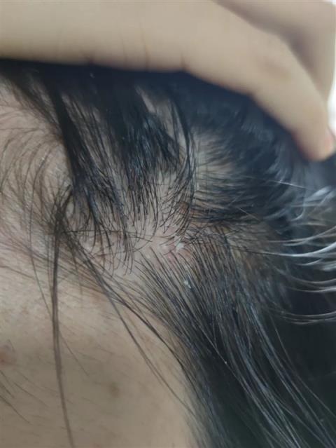 与银屑病斗争16年 我曾以为这辈子都找不到对象(图2)