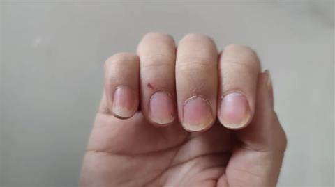 与银屑病斗争16年 我曾以为这辈子都找不到对象(图5)