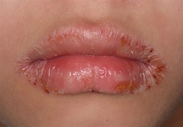 嘴唇总是干裂、起皮:可能不是水喝少了 而是得了这种病!-图3 嘴唇总是干裂、起皮:可能不是水喝少了 而是得了这种病!-图3