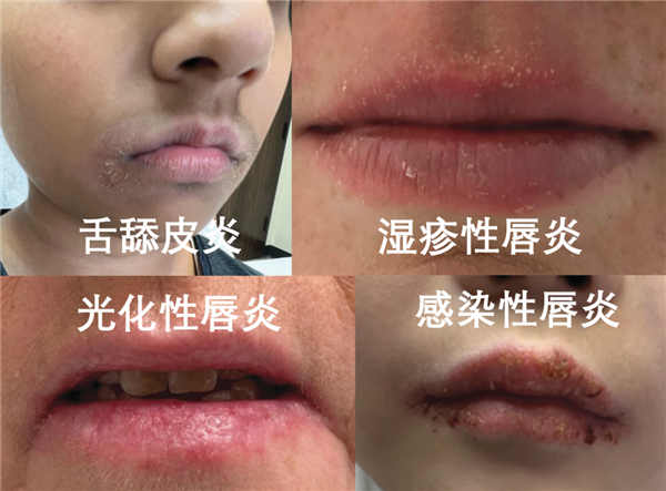 嘴唇总是干裂、起皮:可能不是水喝少了 而是得了这种病!-图4 嘴唇总是干裂、起皮:可能不是水喝少了 而是得了这种病!-图4